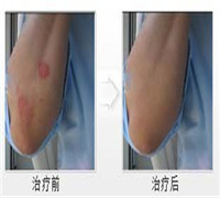 胸部患有牛皮癣要怎么保健呢